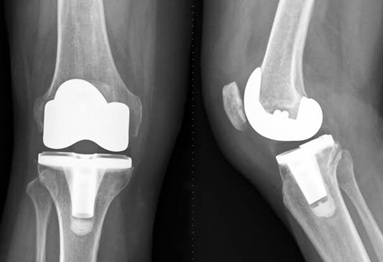 Hip Replacement Hip Replacement
