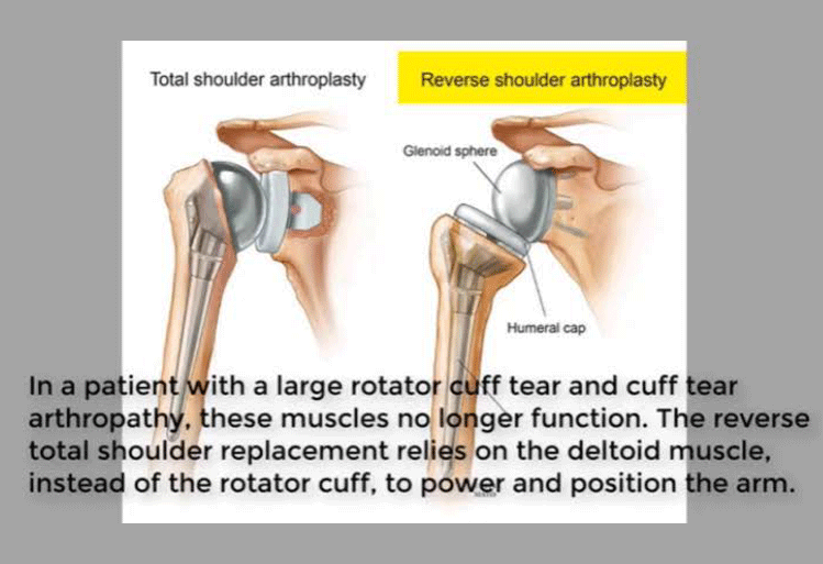 Reverse Total Shoulder Replacement Reverse Total Shoulder Replacement