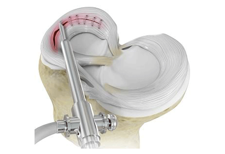 Meniscus Repair Meniscus Repair