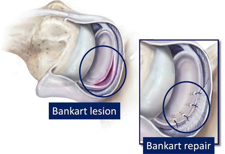 Bankart Repair Bankart Repair