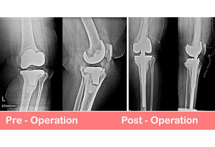 Revision Knee & Hip Replacement Revision Knee & Hip Replacement