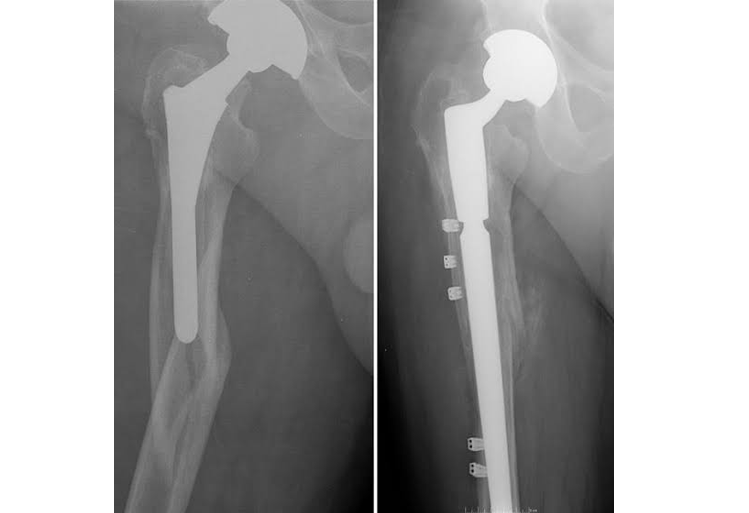 Revision Knee & Hip Replacement Revision Knee & Hip Replacement