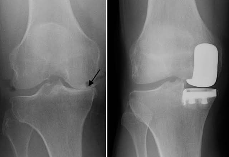 Partial Knee Replacement Partial Knee Replacement