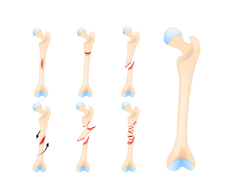 Bone Fracture