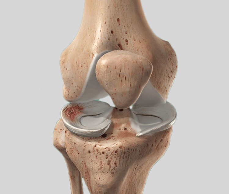 Meniscus Repair Meniscus Repair