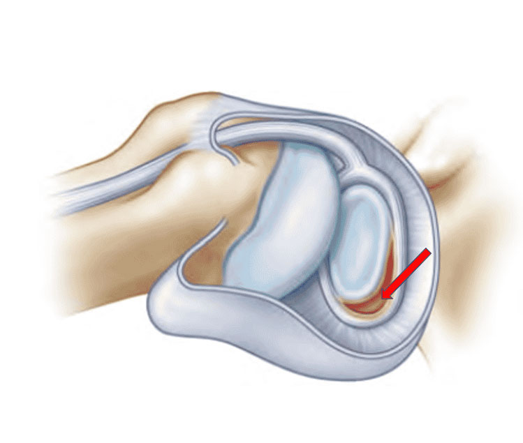 Bankart Repair Bankart Repair