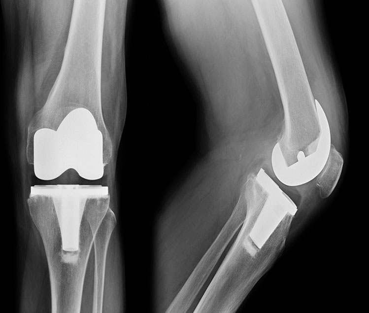 Revision Knee & Hip Replacement Revision Knee & Hip Replacement