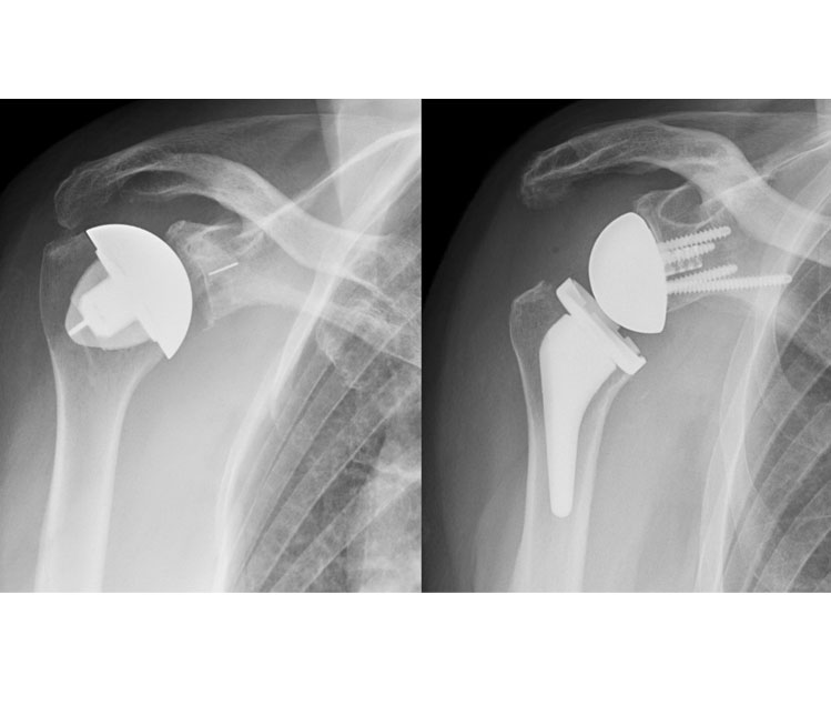 Reverse Total Shoulder Replacement Reverse Total Shoulder Replacement